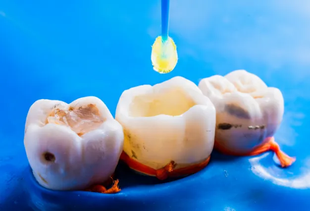 Dental Filling Service Scarsdale NY Dental Filling Service Scarsdale NY