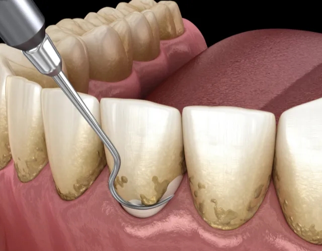 Periodontal Care service Periodontal Care service