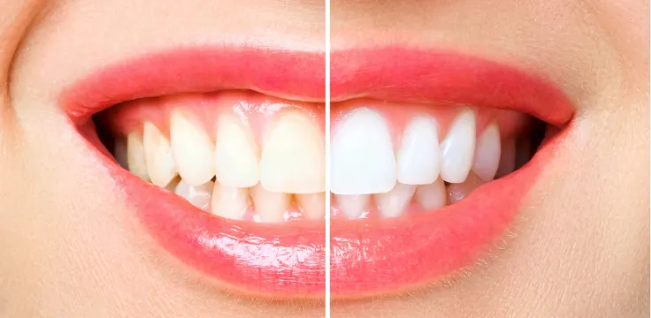 Teeth Whitening Service Scarsdale NY