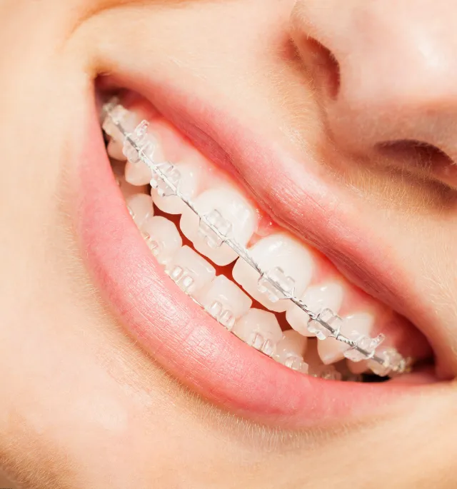 cosmetic braces services