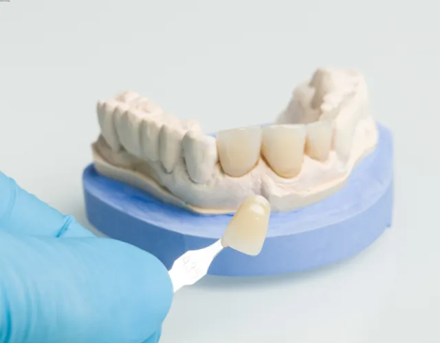 dental veneers service scarsdale ny dental veneers service scarsdale ny