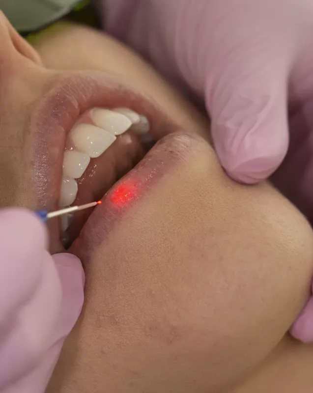 Cold Sore Laser Therapy in Scarsdale Cold Sore Laser Therapy in Scarsdale