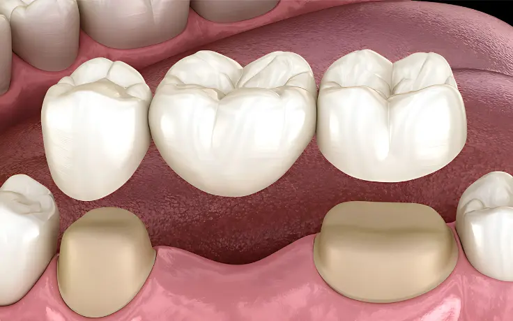 Dental Bridges Services Scarsdale
