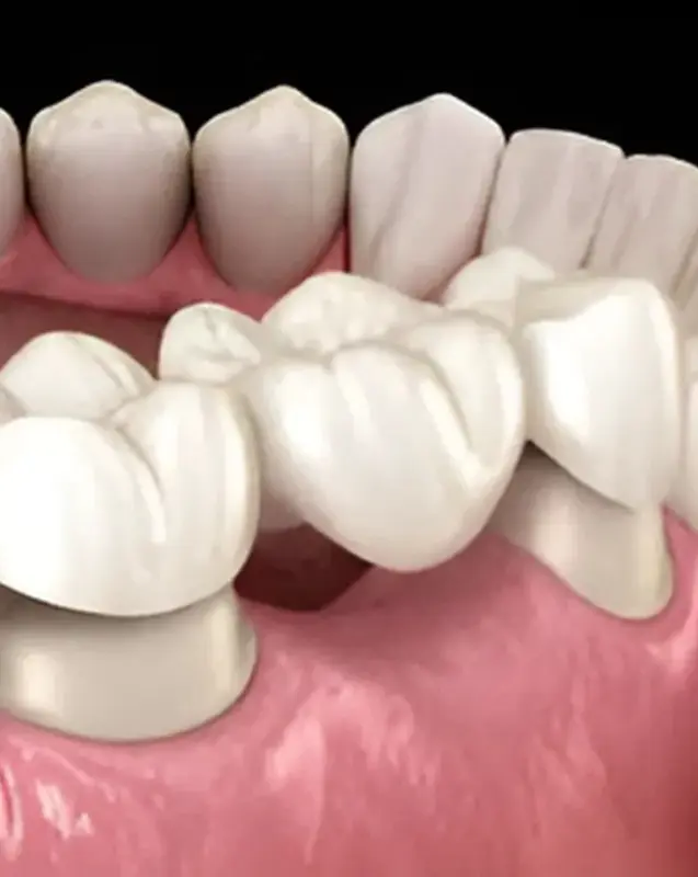 Dental Bridges in Scarsdale