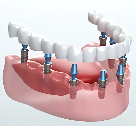 Dental Implant Scarsdale NY