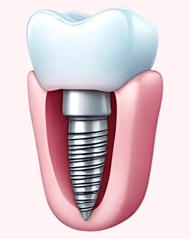 Dental Implant Services in Scarsdale
