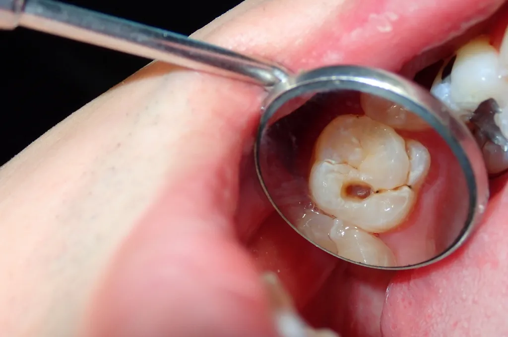What is Dental Cavity Treatment