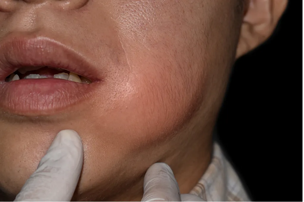 What is a Dental Abscess