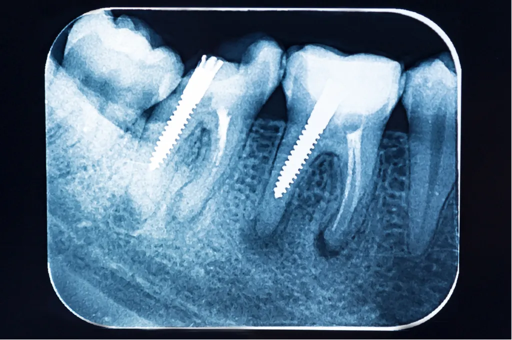 What is a Dental X-Ray