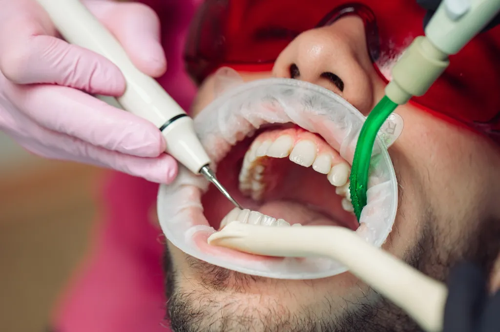 What is a Teeth Cleaning