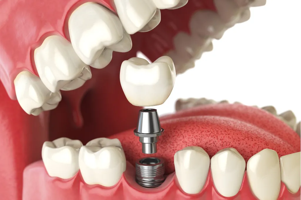 Why Choose Us for Bone Graft Surgery In Scarsdale