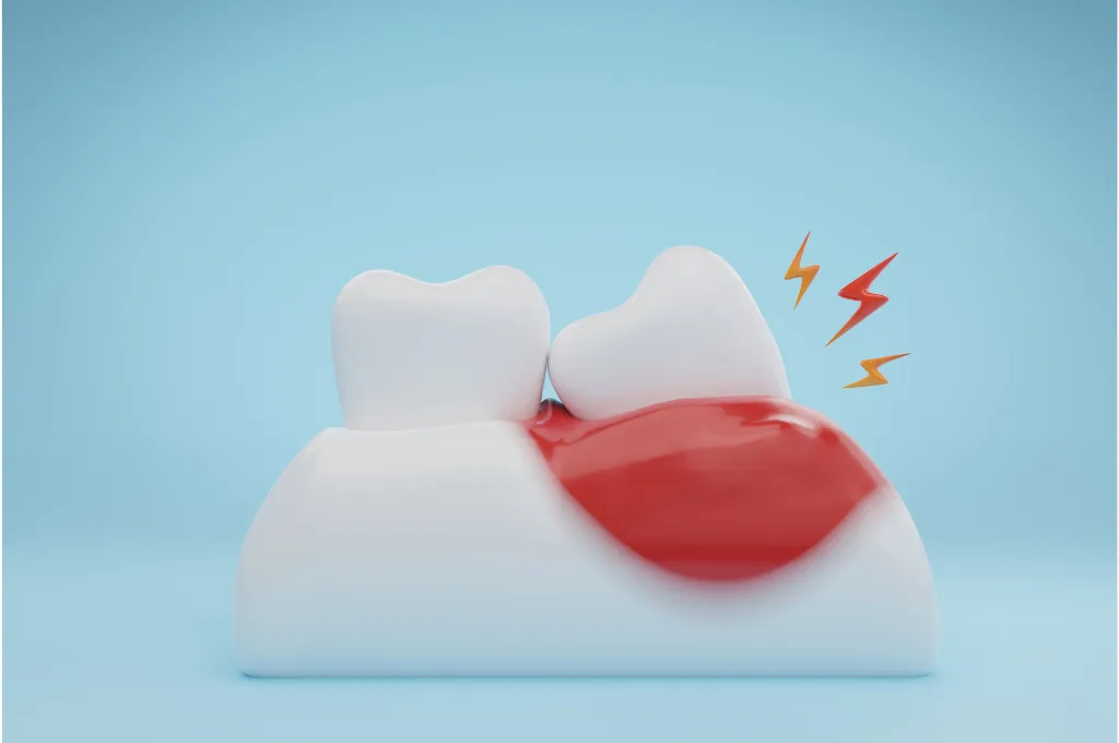 Why Choose Us for Gum Disease Treatment