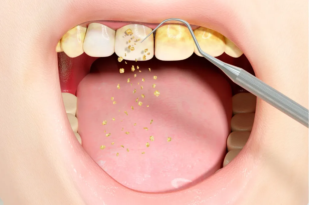 Why Choose Us for Teeth Cleaning