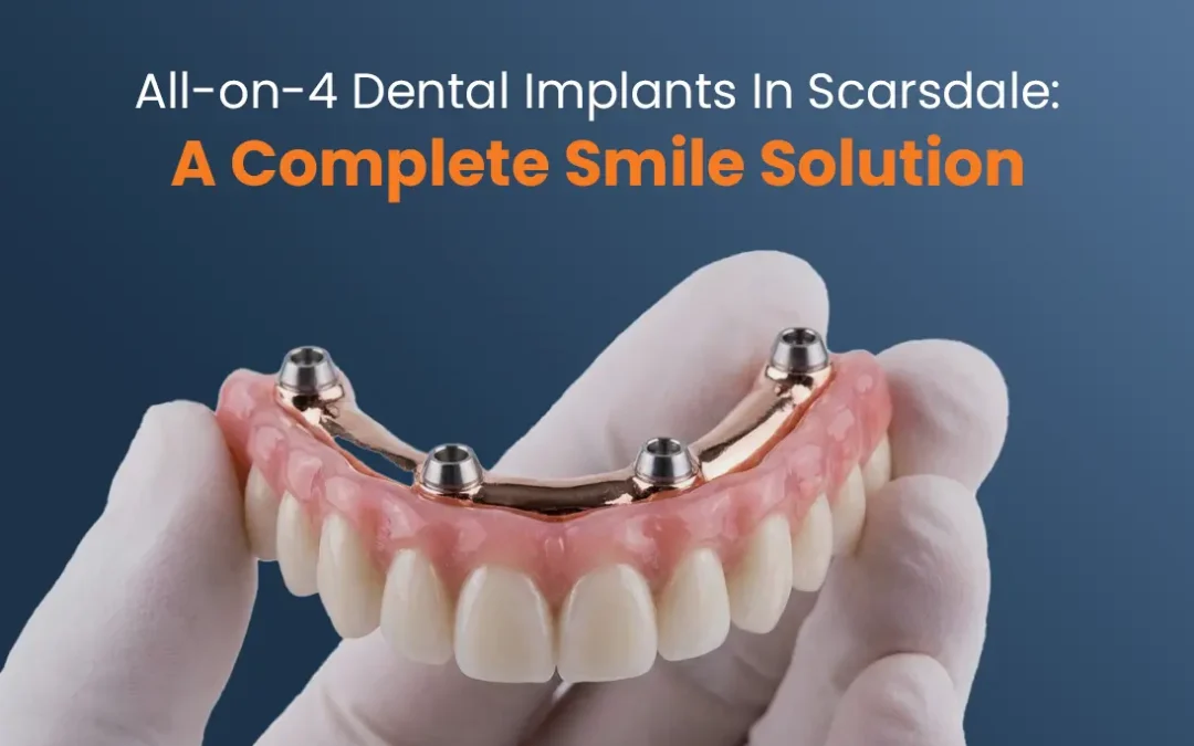 All-on-4 Dental Implants in Scarsdale: A Complete Smile Solution