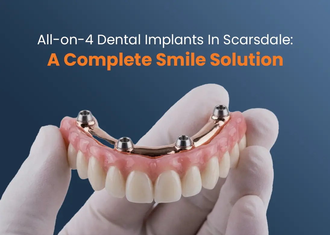 All-on-4 Dental Implants in Scarsdale A Complete Smile Solution