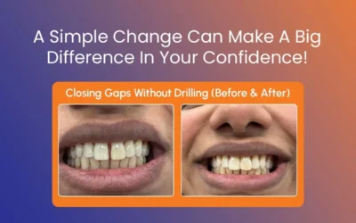 Bioclear for Tooth Gaps: A Conservative Smile Treatment Plan
