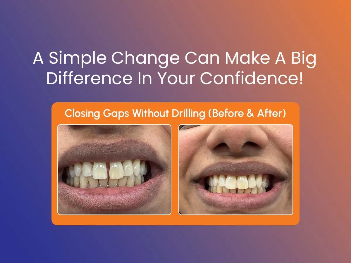 Bioclear for Tooth Gaps