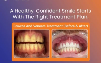 Dental Erosion Treatment: How to Restore Worn, Damaged Teeth