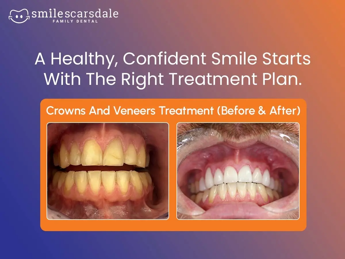 Dental Erosion Treatment How to Restore Worn, Damaged Teeth