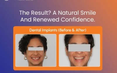 Dental Implant After Orthodontic Treatment: What Comes Next?