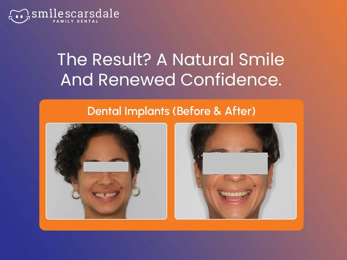 Dental Implant After Orthodontic Treatment: What Comes Next?